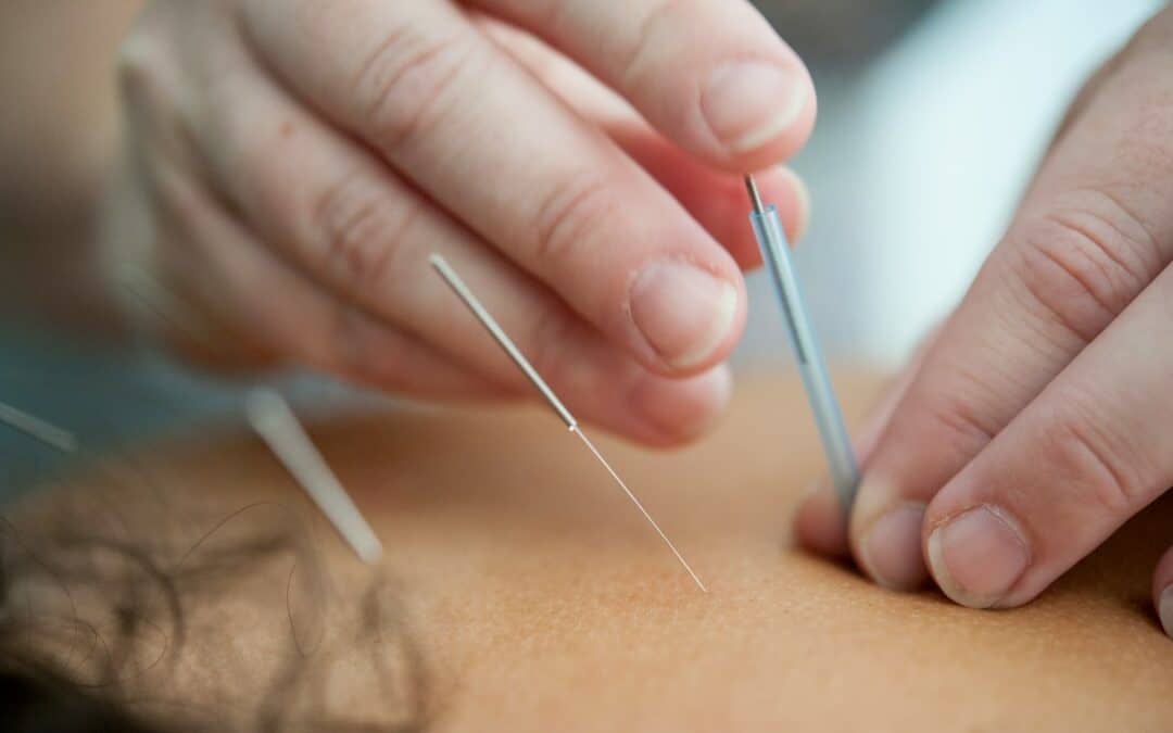 Acupuncture for Chronic Headache Relief: Exploring the Benefits and Treatment Options