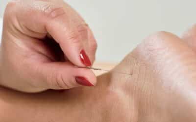 Supporting Your Fertility through Acupuncture Sessions